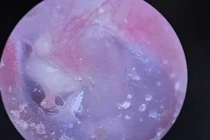 Bé trai 6 tuổi mắc bệnh cholesteatoma tai giữa phá hủy xương