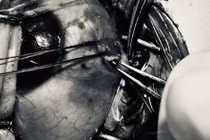 Bệnh nhân bị đinh sắt bắn vào mắt suýt thủng nhãn cầu