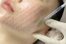 Cẩn trọng với 'bẫy' làm đẹp siêu tốc cận Tết