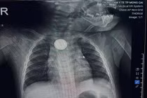 Bé 11 tháng tuổi bỏng loét thực quản vì nuốt pin cúc áo