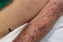 Cụ bà 73 tuổi bán lòng mắc liên cầu lợn, bác sĩ cảnh báo