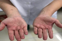 Điều trị hội chứng ống cổ tay bằng phương pháp cổ truyền