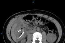 Bé gái 13 tuổi phải phẫu thuật cấp cứu vì nuốt nhiều xương gà