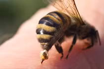 Cứu sống bệnh nhân bị ong vò vẽ đốt gây sốc phản vệ độ II 