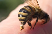 Cứu sống bệnh nhân bị ong vò vẽ đốt gây sốc phản vệ độ II 