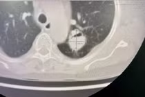 Người phụ nữ bị u nấm phổi phức tạp được phẫu thuật thành công