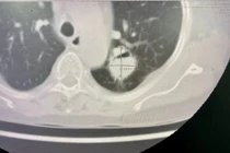 Người phụ nữ bị u nấm phổi phức tạp được phẫu thuật thành công