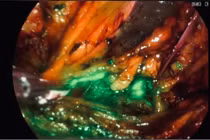 Ứng dụng kỹ thuật mới điều trị ung thư nội mạc tử cung