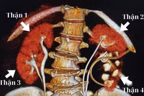 Người phụ nữ có tới 4 quả thận - dị tật bẩm sinh cực hiếm 