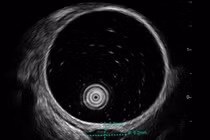 Không triệu chứng đi khám phát hiện u dưới niêm mạc