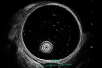 Không triệu chứng đi khám phát hiện u dưới niêm mạc