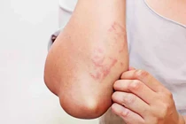 Nhiễm giun sán có thể gây ra nhiều vấn đề sức khỏe nghiêm trọng