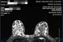 Người phụ nữ bị biến chứng ngực nặng sau làm đẹp tại cơ sở 'chui'