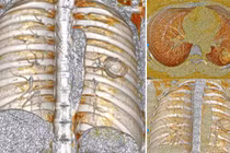 Ung thư phổi tế bào nuôi - căn bệnh nguy hiểm, hiếm gặp