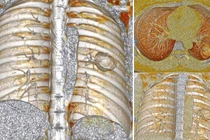 Ung thư phổi tế bào nuôi - căn bệnh nguy hiểm, hiếm gặp