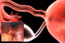 Phẫu thuật cấp cứu thành công cho bé gái 14 tuổi mắc u nang buồng trứng xoắn