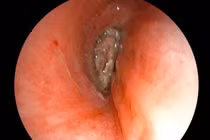 Người phụ nữ 57 tuổi hóc dị vật hạt kha tử gây tắc đường thở