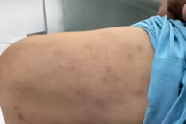 Người đàn ông được chẩn đoán bệnh tự miễn nguy hiểm liên quan đến thuốc