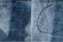 Cứu sống bệnh nhân nhồi máu cơ tim sau mổ nội soi tại Quảng Ninh