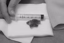 Bệnh nhân nuốt phải hàm răng giả, được cấp cứu nội soi gắp dị vật thành công