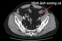 Người đàn ông bị xương cá dài 4 cm đâm thủng ruột non nguy hiểm