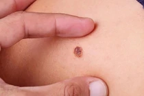 Dấu hiệu nhận biết ung thư da