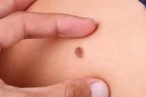 Dấu hiệu nhận biết ung thư da