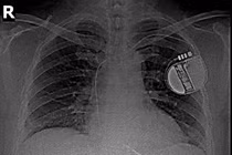 Cấy máy khử rung tim, cứu sống bệnh nhân mắc rối loạn nhịp tim nguy hiểm