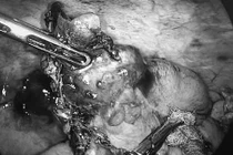 Ung thư ruột thừa hiếm gặp được phát hiện trong ca phẫu thuật cấp cứu