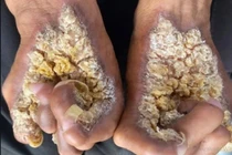 Người đàn ông ở Ninh Bình mắc hội chứng 'người cây' nguy hiểm ra sao?