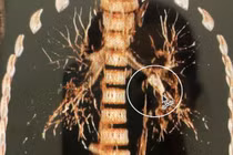 Cứu sống bé 7 tuổi bị hóc đầu bút bi vào đường thở