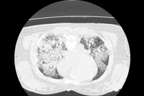 15 ngày giành sự sống cho nữ bệnh nhân 43 tuổi bị đuối nước mặn nguy kịch