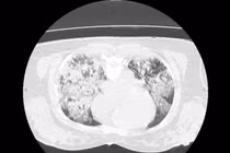 15 ngày giành sự sống cho nữ bệnh nhân 43 tuổi bị đuối nước mặn nguy kịch