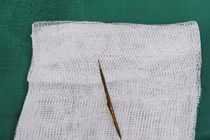 Một bệnh nhân nam bị thủng ruột non do dị vật tăm tre