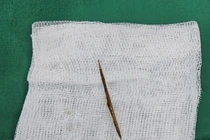 Một bệnh nhân nam bị thủng ruột non do dị vật tăm tre