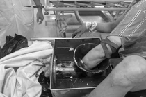 Mất bàn tay do sơ suất khi vệ sinh máy xay thịt