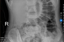 Bé gái 5 tuổi bị táo bón kéo dài gây tiểu dầm hàng đêm