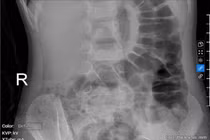 Bé gái 5 tuổi bị táo bón kéo dài gây tiểu dầm hàng đêm