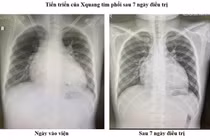 Điều trị thành công ca bệnh suy tim nặng ở trẻ em theo phác đồ mới 