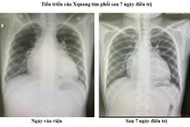 Điều trị thành công ca bệnh suy tim nặng ở trẻ em theo phác đồ mới 