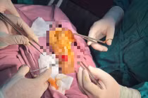 Cứu người phụ nữ bị đứt động mạch quay do dao cắt