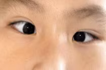 Chứng lác mắt ở trẻ tăng do sử dụng thiết bị điện tử