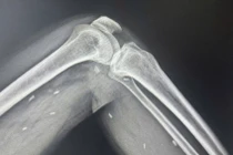 Phát hiện các mô vùng xương đùi, cẳng chân một bệnh nhân có nhiều kén sán