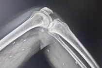 Phát hiện các mô vùng xương đùi, cẳng chân một bệnh nhân có nhiều kén sán