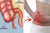 Chủ quan đau bụng kéo dài, người đàn ông 36 tuổi bị vỡ ruột thừa nguy kịch