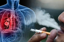 Ngăn ngừa ung thư qua kiểm soát yếu tố nguy cơ