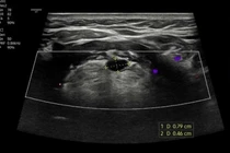 Nữ bệnh nhân 56 tuổi mắc dị tật nang ống giáp lưỡi hiếm gặp