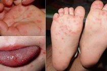 Hà Nội ghi nhận ca mắc bệnh tay chân miệng tăng mạnh, tiềm ẩn biến chứng nặng