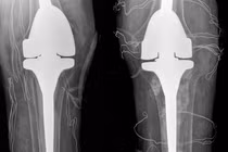 Người đàn ông biến dạng khớp gối vì chữa gout bằng thảo dược trôi nổi