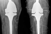 Người đàn ông biến dạng khớp gối vì chữa gout bằng thảo dược trôi nổi